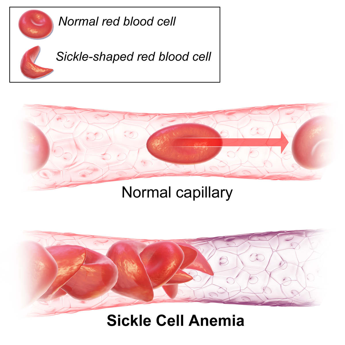 Deformed red blood cells in patients with sickle cell anemia (Source: Wikipedia)